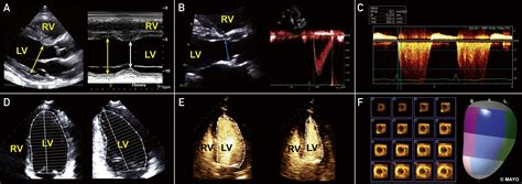 Echocardiographic Assessment of Left Ventricular Systolic .